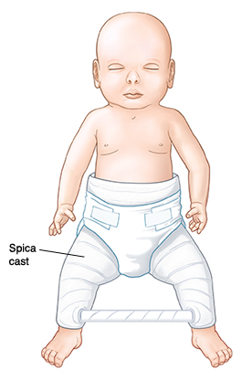 Developmental Dysplasia Of The Hip In Children